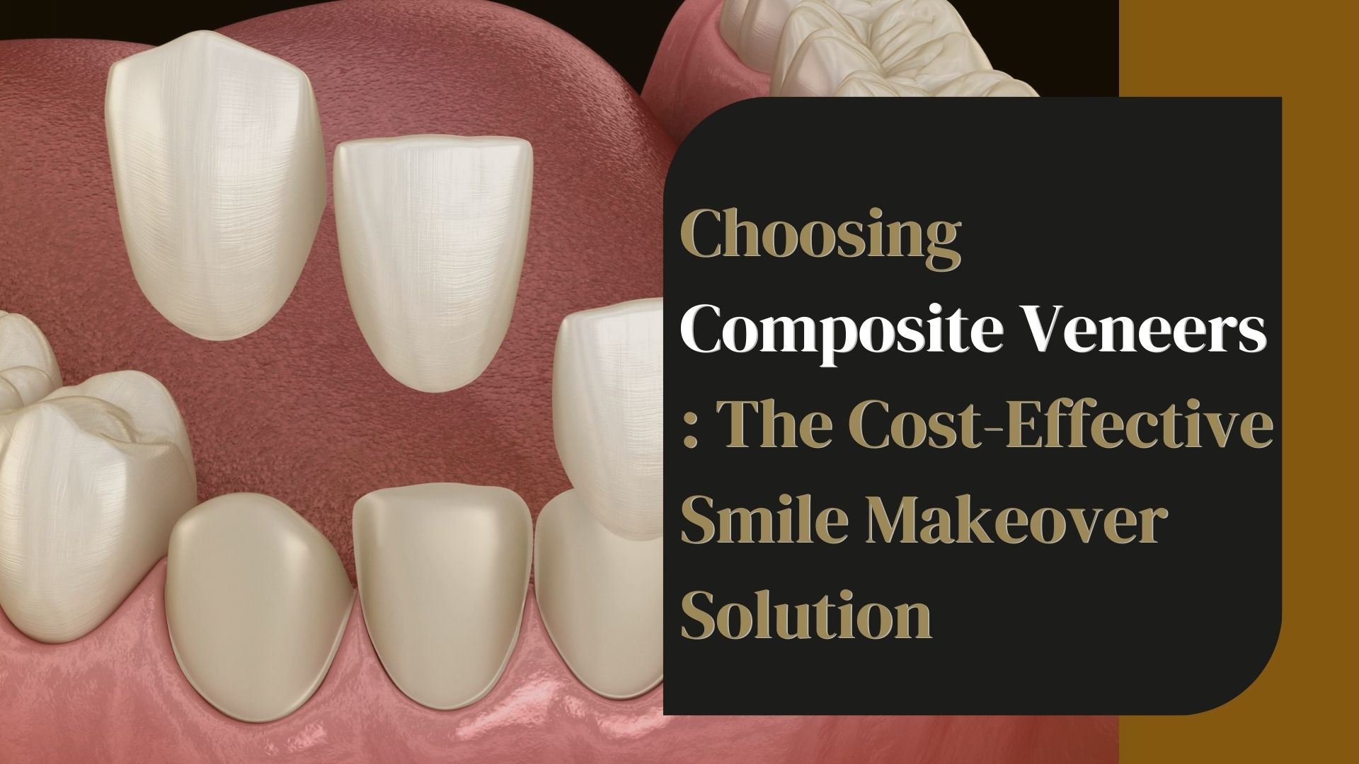 Choosing Composite Veneers: The Cost-Effective Smile Makeover Solution